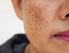 MELASMA