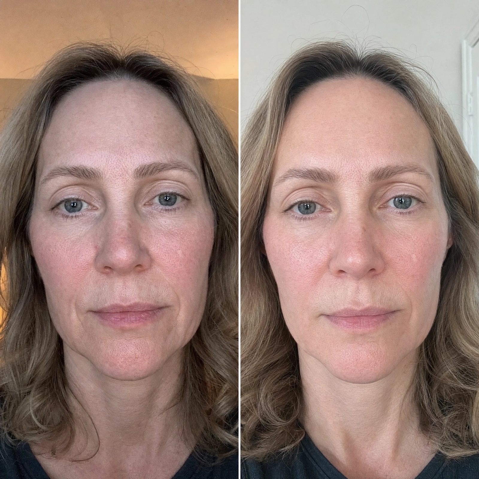 Before and after — dry, crepey skin texture