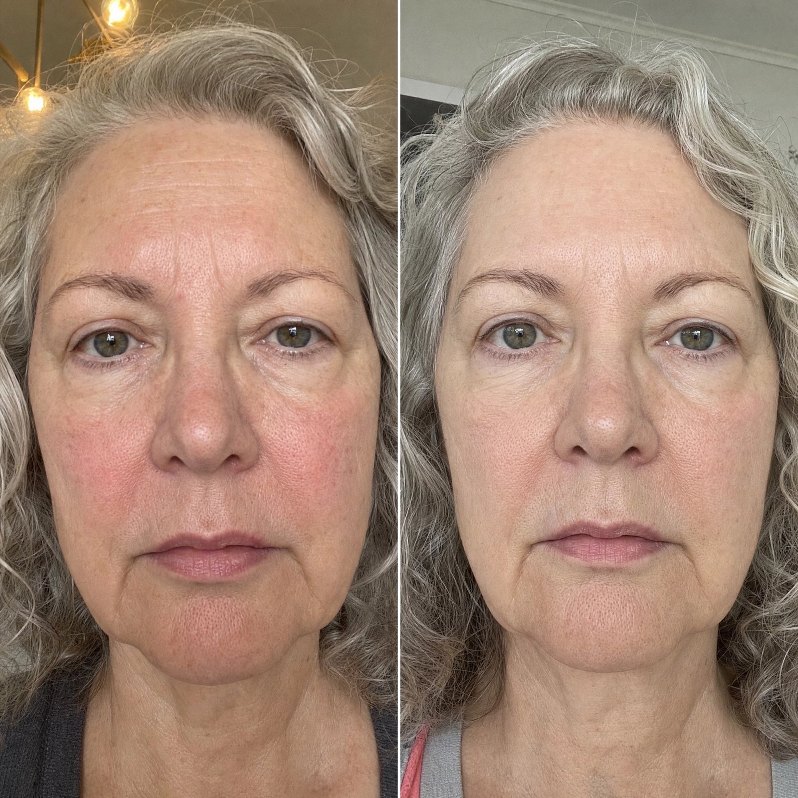 Before and after — under-eye area