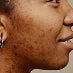 DARK SPOTS