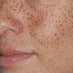AGE SPOTS